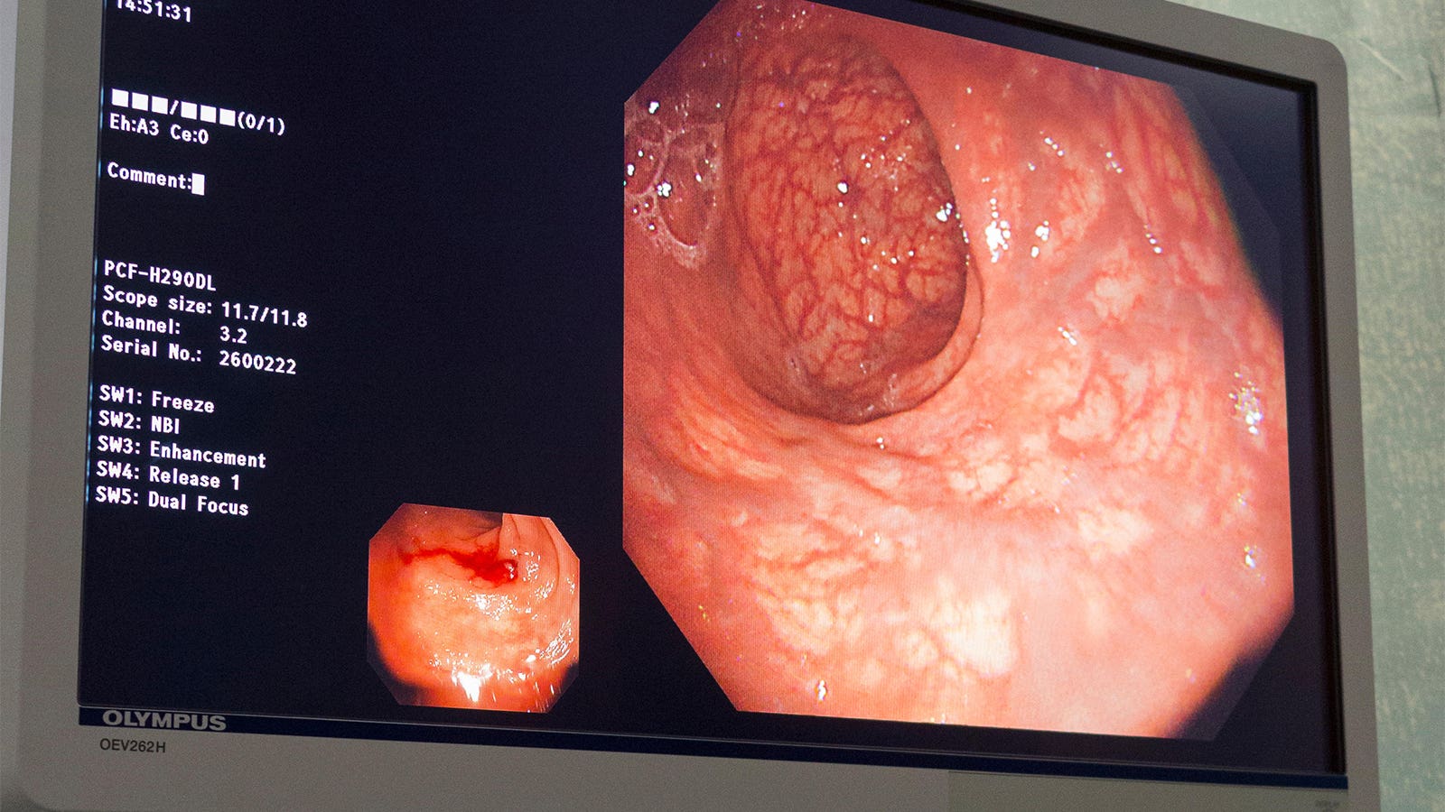Aumento de la participación en la detección del cáncer colorrectal con invitación a la prueba FIT