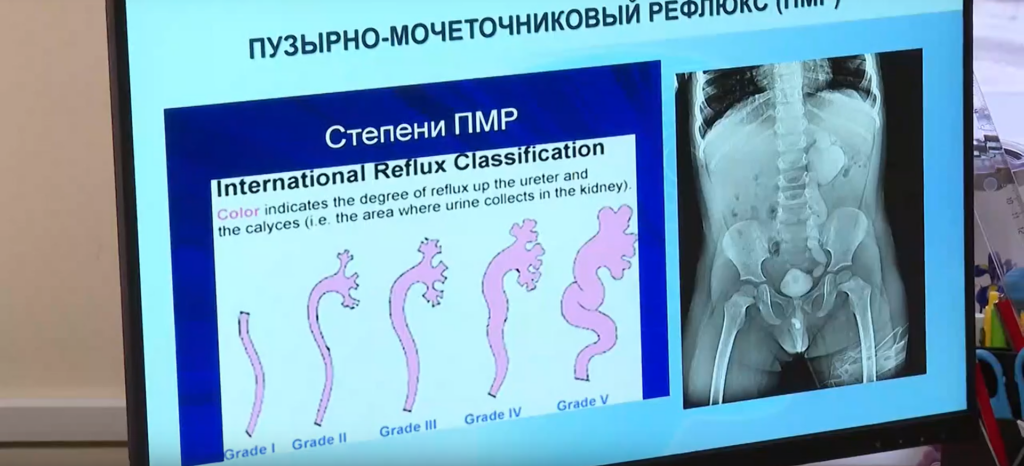Диагностика рефлюкса за 5 минут: новгородские урологи представили инновационный метод