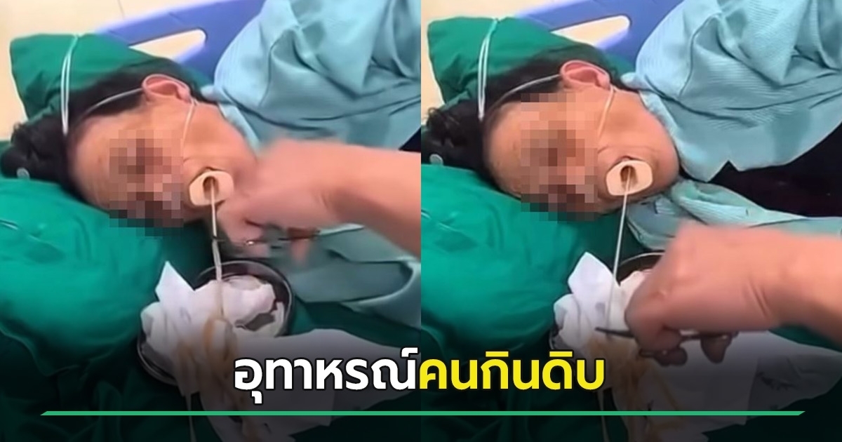 คลิป устрашаacas อีซ้อขยี้ข่าว : อีซ้อ ลงวิดีโอพยาธิออกจากปากคนไข้ น่ากลัว!