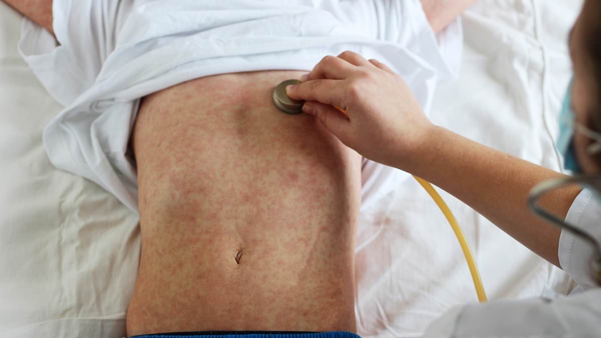 Measles Outbreak: Australia on High Alert as New Cases Emerge - Check the Latest Exposure Sites