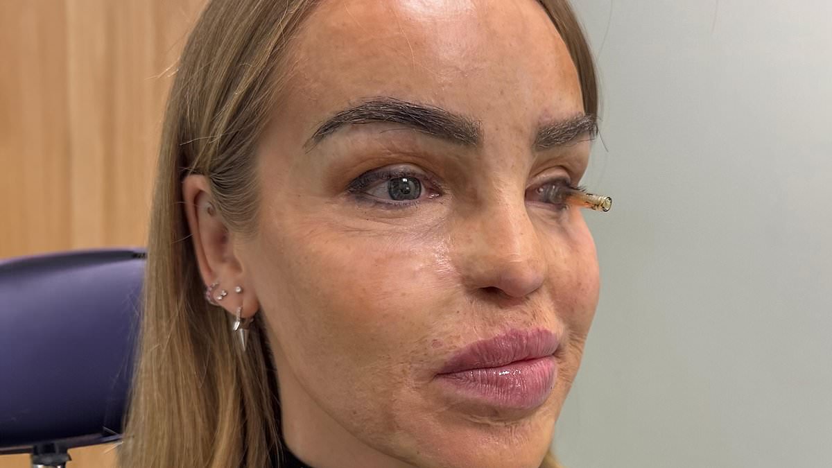 Katie Piper shares emotional health update after undergoing eye surgery: 'I've reached the end of the road'