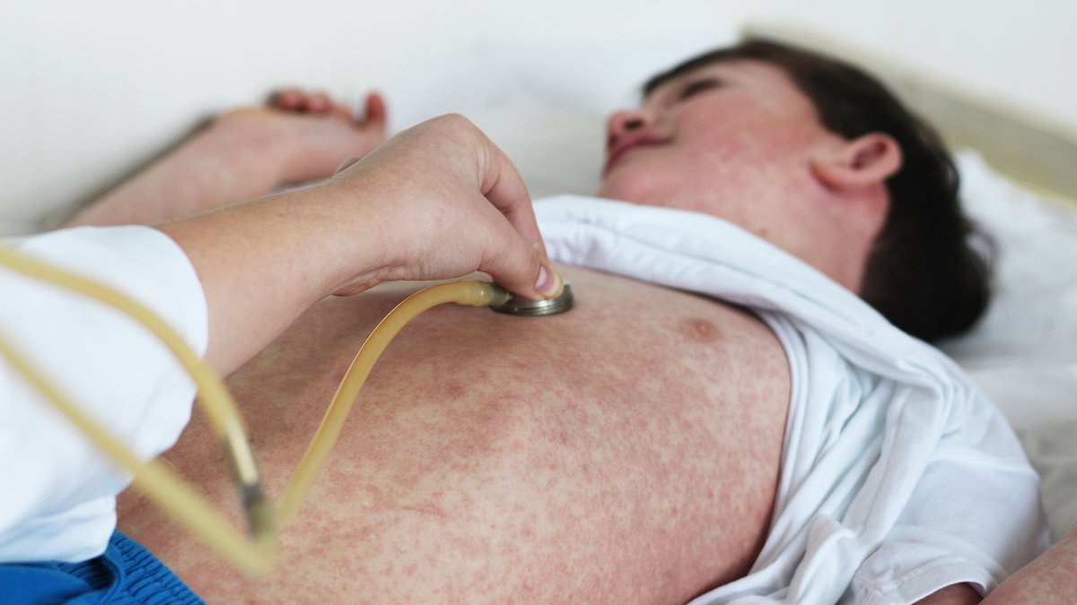 Measles Outbreak Spreads: Over 20 Cases Confirmed in Texas and New Mexico