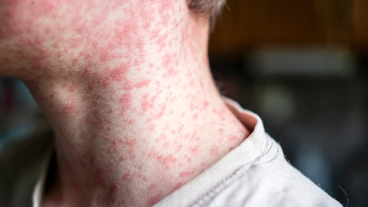 UK Vaccine Update: Major Schedule Change Announced to Combat Rising Child Infection Rates