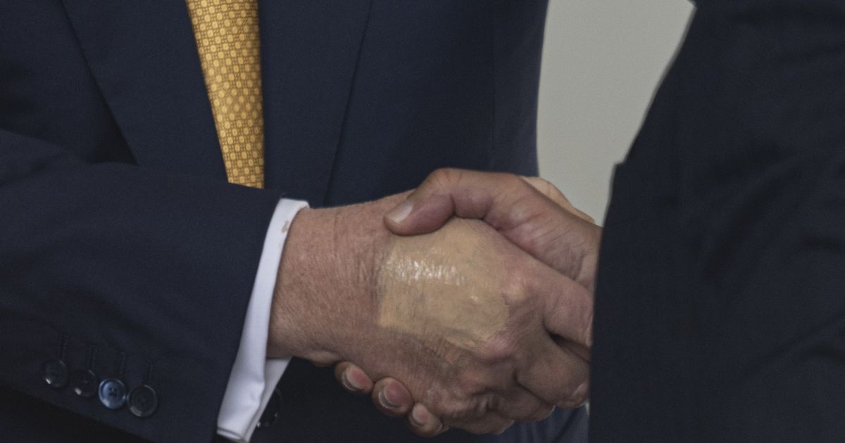 Donald Trump's health condition CVI explained after make-up on hand