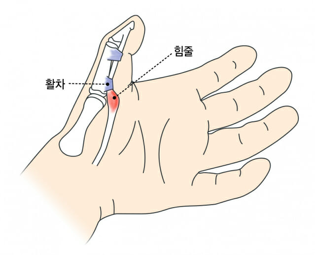 손가락 '딸깍' 소리 주의! 50대 발병률 높은 방아쇠 손가락, 원인과 예방법