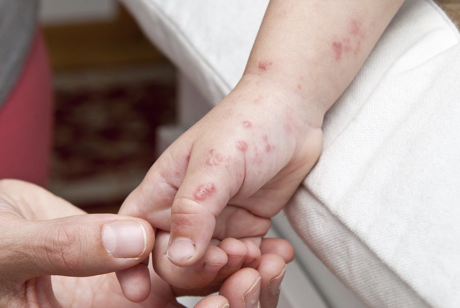 Brote de varicela en el Bauzá: directora de Salud proyectó más casos para próximos días