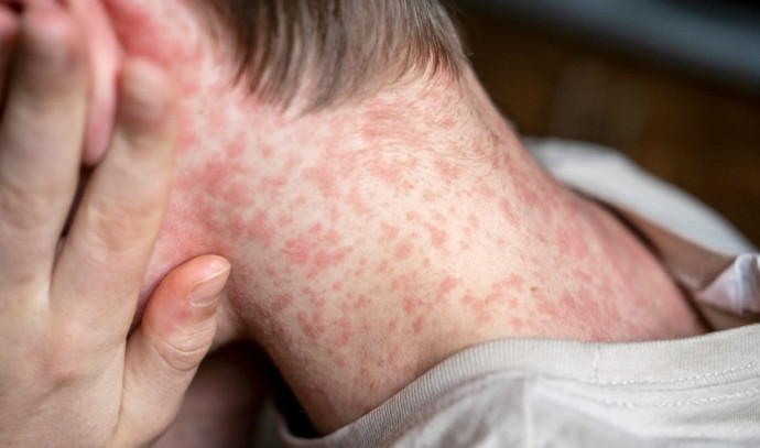 Measles Scare in Israel: Cases Surge Past 60, Health Officials Urge Vaccination