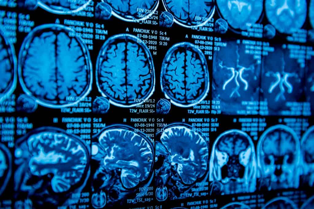 Vitamina B12: Níveis Considerados 'Normais' Podem Afetar a Saúde Cognitiva