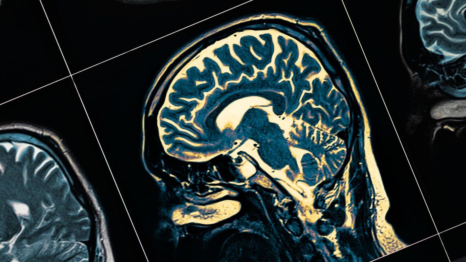 Gehirnalterung beschleunigt: Forscher entdecken Ursache für psychische Erkrankungen