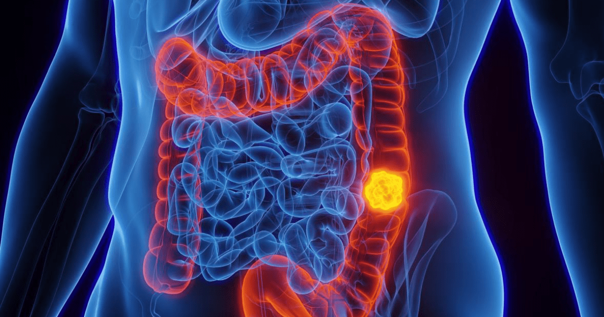 Cuatro signos del cáncer de intestino que pueden pasar desapercibidos