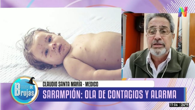 ¡Alerta Roja! Argentina Enfrenta una Nueva Ola de Sarampión: Expertos Urgen a la Vacunación