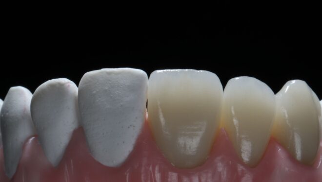 Lentes de contato dentais: transforme seu sorriso com tecnologia avançada