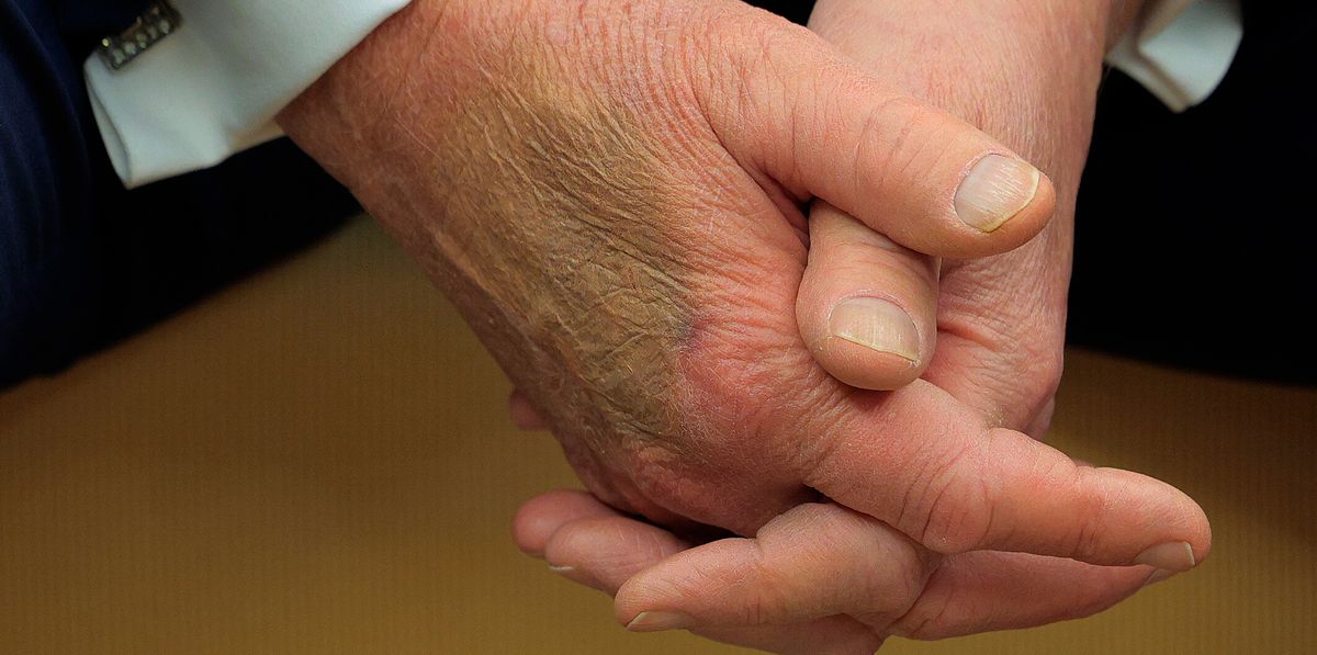 Mystery Bruise on Trump's Hand: White House Offers Surprising Explanation