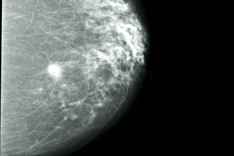 Récidives de cancer du sein Santé Canada approuve une seconde option de traitement
