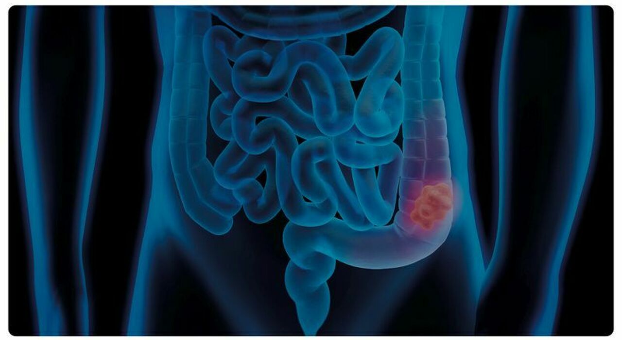 Tumori, le donne si ammalano più degli uomini: colpa di alcol e fumo. Il secondo bicchiere aumenta del 27% il rischio di cancro al seno