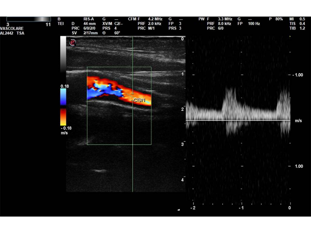 Ecocolordoppler: la soluzione non invasiva per la salute del sistema circolatorio