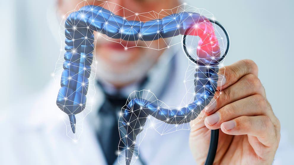 ¿Por qué aumentan los casos de cáncer colorrectal en jóvenes menores de 50 años?