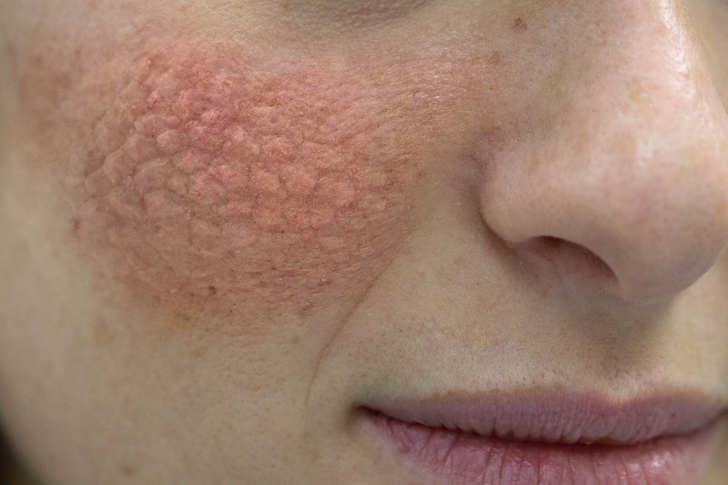 Lupus: mode de vie et soins naturels pour contenir les symptômes