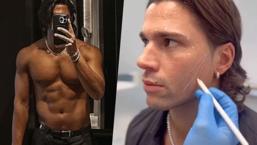 Luca Onestini Svela il Segreto del suo Look Rinnovato dopo il Filler al Viso